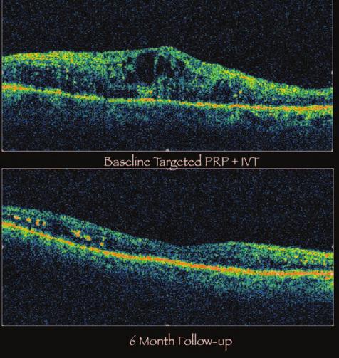 Figure 7 shows the laser treatment directed at the most ischemic areas.