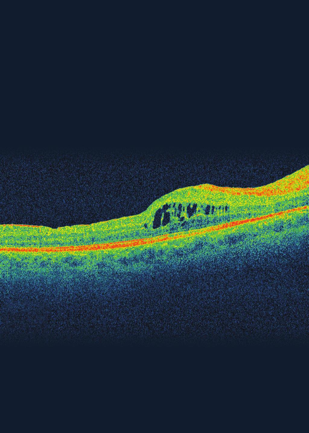 New Insights Into the Management of Diabetic Macular Edema and Related Conditions Highlights of a symposium held in New York City. Contents 4 Laser Therapy s Role in Managing DME By Susan B.