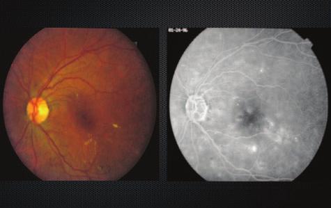 NEW INSIGHTS INTO THE MANAGEMENT OF DIABETIC MACULAR EDEMA AND RELATED CONDITIONS Exploring the Potential of Combination Therapies for DME While laser monotherapy remains the gold standard,