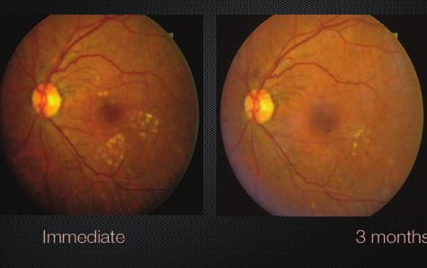 BROWN, MD From the Early Treatment Diabetic Retinopathy Study (ETDRS), we know laser treatment is the primary and only proven therapy for clinically significant macular edema.
