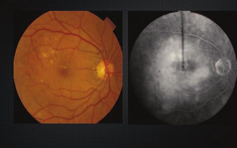 HIGHLIGHTS OF A SYMPOSIUM HELD IN NEW YORK CITY (Image courtesy of David Boyer, MD.) (Image courtesy of David Boyer, MD.) Figure 3. Before grid laser treatment. Figure 4. After grid laser treatment.