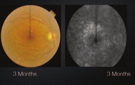 The difference between the use of these agents in age-related macular degeneration (AMD) is that in AMD, there is only minimal VEGF.