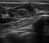 Medial Approach to the Through the Pronator