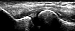 Synovial fringe extends from synovial membrane.