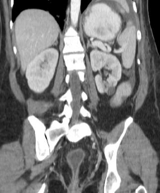 dificile positive Started on IV metronidazole by OB CT scan: Dilated small bowel