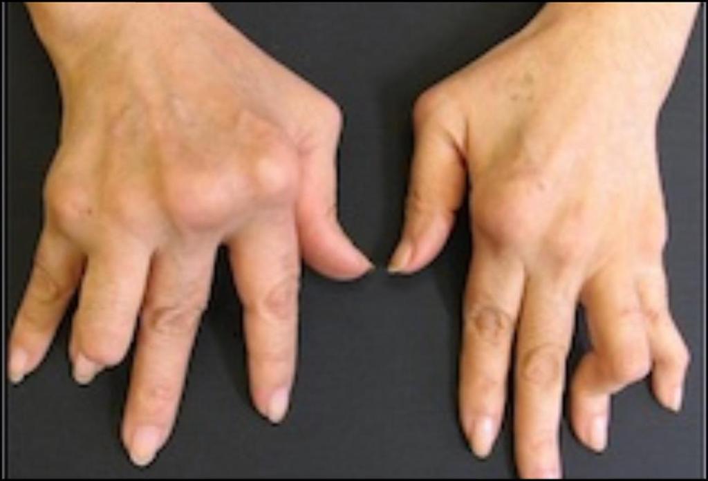 Recognize early signs of RA/PsA what to ask, what to look for RA Synovitis (swelling, effusion, warmth, pain) Symmetric joint