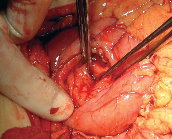 duodenal injuries Gr IV pancreas head injuries Post op