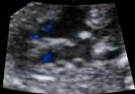 ) fetal cases Associated anomalies in 50% RVOT obstruction AVSD +/-