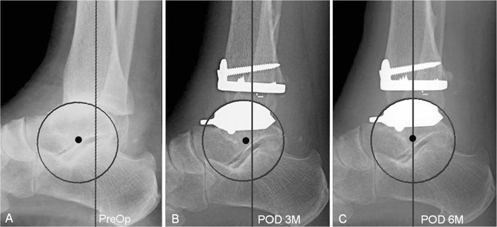 Lee et al. BMC Musculoskeletal Disorders 2013, 14:260 Page 5 of 9 Figure 2 A 42-year-old woman who underwent primary total ankle arthroplasty (A,B,C) for ankle osteoarthritis.