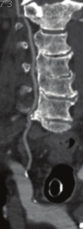 CHALLENGING CASES Figure 1 or a direct common carotid artery puncture. CTA may also provide a clue as to the source of occlusion.