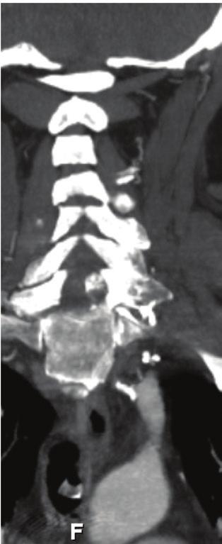 If tandem lesions are present, administration of rectal aspirin and stenting the occluded cervical segment may be necessary.