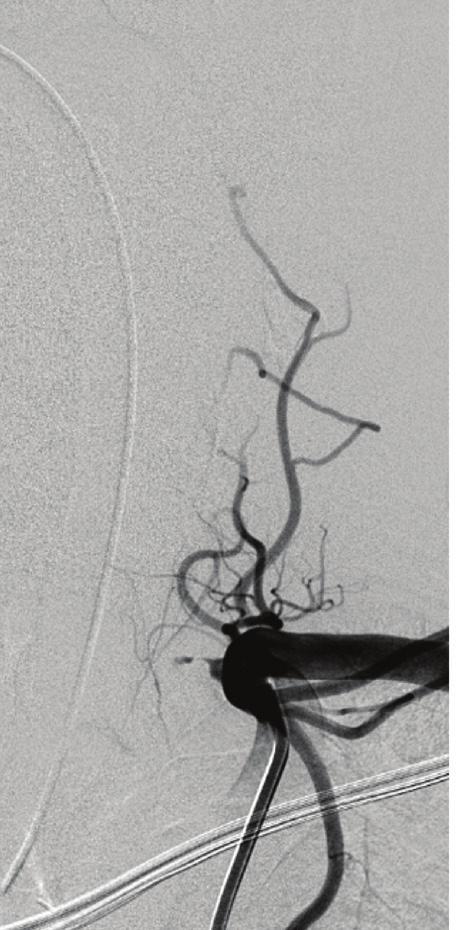 Left subclavian artery angiography confirms the occlusion at the origin of the LVA (Figure 2). How would you proceed? Dr.