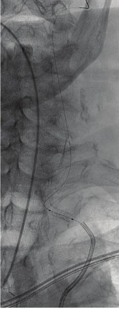 After crossing the LVA origin, I would attempt to achieve a stable platform for thrombectomy, ideally with the intermediate catheter beyond the proximal occlusion, which is a distal-to-proximal