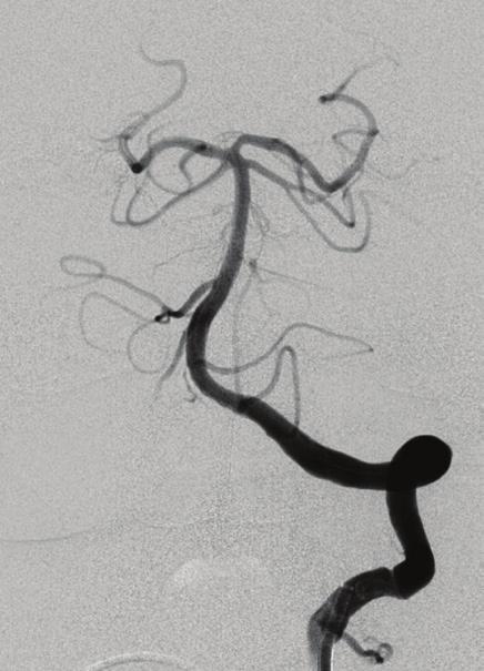Prior to stenting, primary angioplasty is always attempted to see if adequate and stable inflow can be established. Dr.