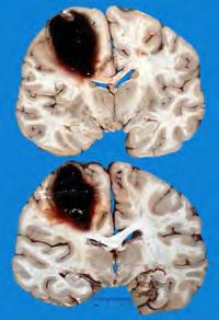 Lobar Hematoma Minimal uncal and left to right subfalcine Narrowing of left lateral ventricle Hypertension and cerebral amyloid