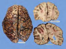 Territory Infarct Smooth brain profile Left to right subfalcine Left ventricular effacement Thrombotic occlusion at site of atheroma