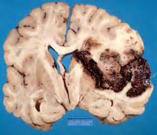 Haemorrhagic Infarct in Territory of Major Branch of Right Middle Cerebral Artery Smooth brain profile Right to left subfalcine Early