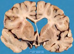 atheroma in great vessels or heart Valve disease Chamber thrombus (atrial fibrillation) Acute Bland Infarct of Left Middle Cerebral