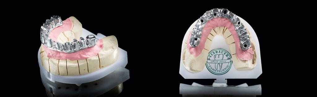 the frame was duplicated together with the model and a saw model was fabricated and scanned in. The data of the provisional bridge provided the full anatomy of the teeth rbach.