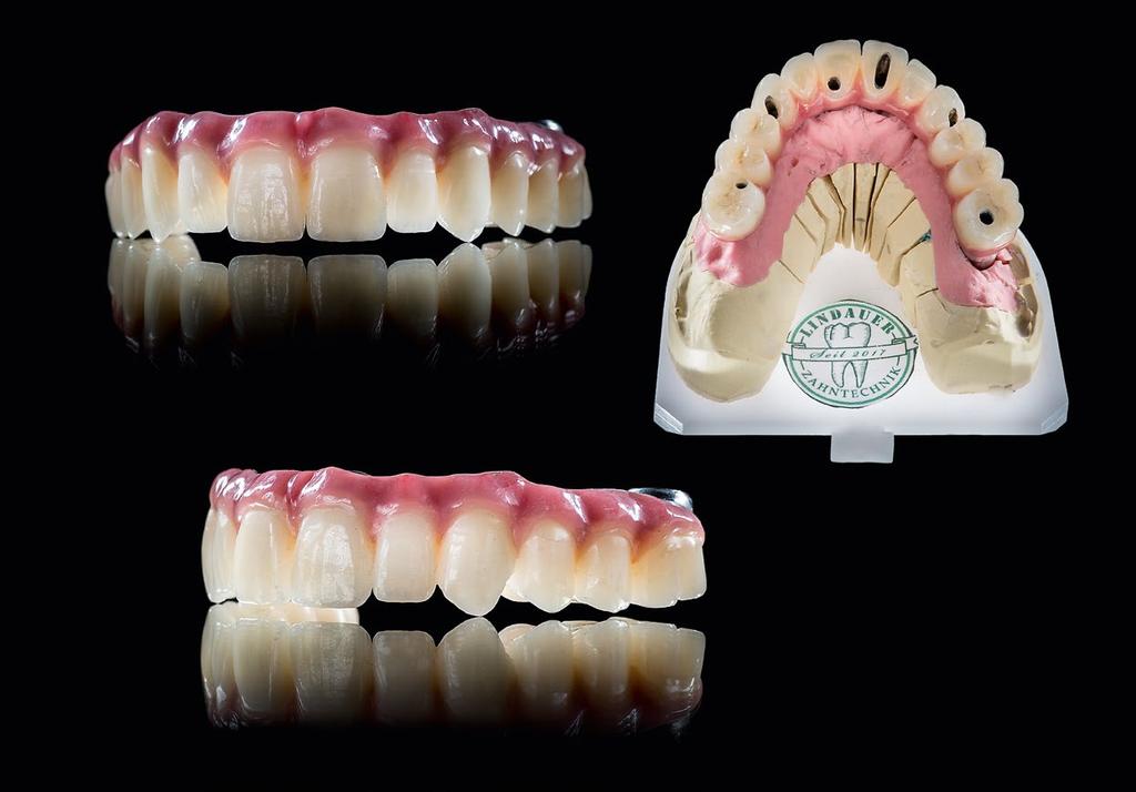 11 The anterior teeth were labially reduced and the posterior teeth were fully anatomically designed