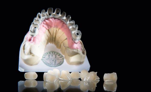 The crowns 12 were milled from the super highly translucent zirconium oxide Zolid FX Multilayer.