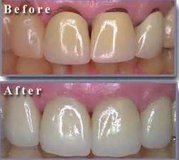 The look of zirconium crowns and bridges is so close to natural teeth that it is hard to tell the dif ference and it is this quality which makes it very useable within dental work.