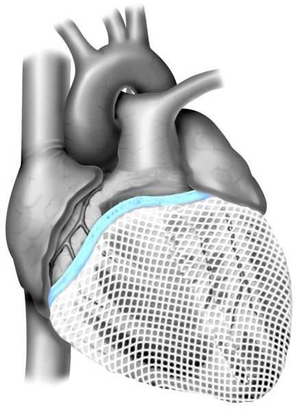 Cardiac support device A fabric mesh device surgically implanted around the heart Provide circumferential