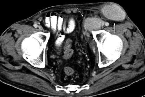 Contrast-enhanced CT scan from the chest to the inguinal region showed enlarged lymph nodes in the left inguinal, left iliac, paraaortic, celiac, porta hepatis and to a lesser degree, the mediastinal