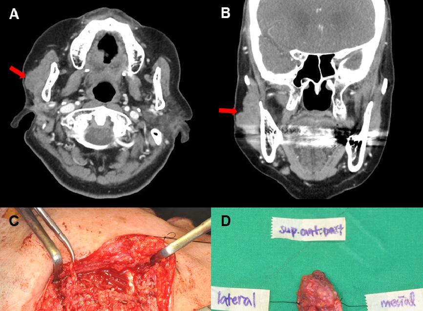 patient re-visited the clinic four months later. A 3D neck CT was taken showing that the mass had enlarged (Fig. 1A, B).