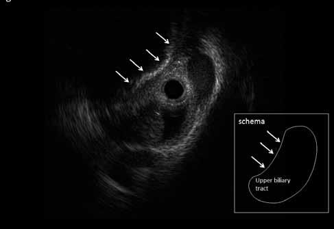 Mirizzi Syndrome with a Biliobiliary Fistula 47 Intraductal ultrasound (IDUS) showed extrinsic compression of the upper biliary tract (white arrows).