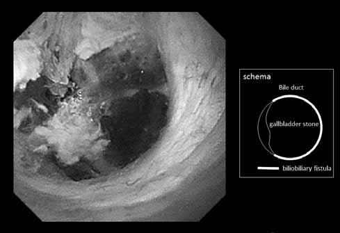 Peroral cholangioscopy (POCS) showed the impacted gallbladder stone exposed to the bile duct at the level of obstruction.