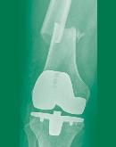 Germany: 27-28 September 2018 Periprosthetic Fractures Hip Knee Upper