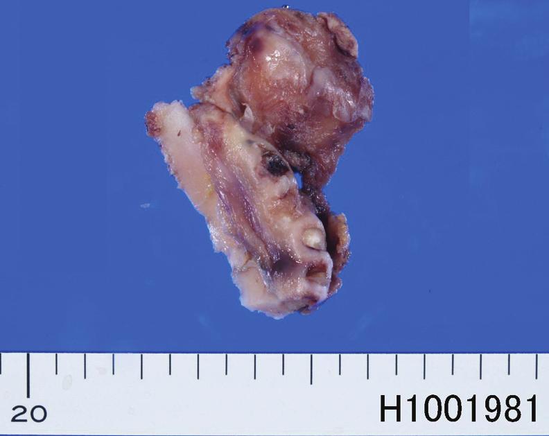 Gingival adenoid squamous cell carcinoma Figure 2. Gross features of the resected tumor and mandible. The tumor (1.5 x 1.5 cm) is somewhat elevated. The margins were negative.