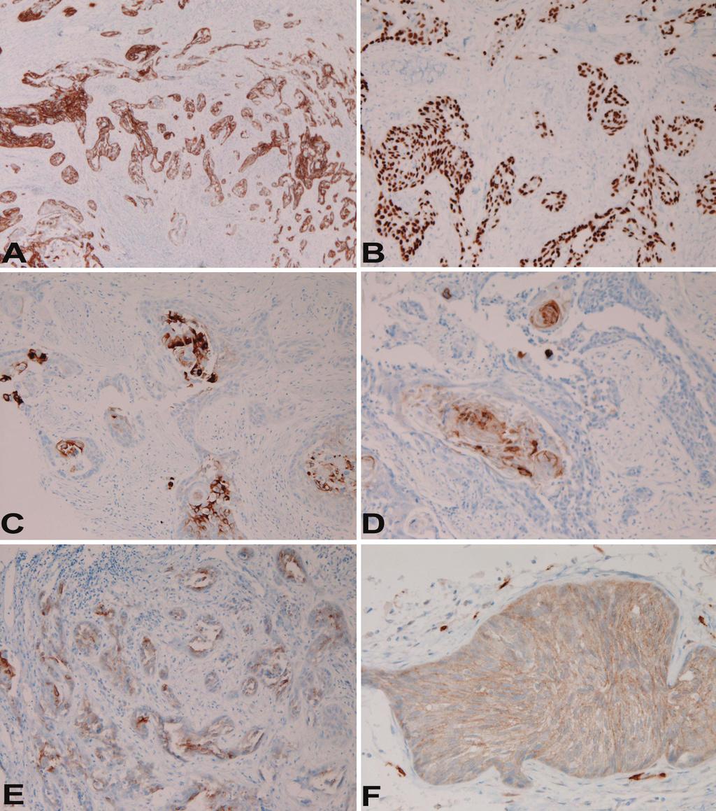 Figure 4. Immunohistochemical features. Both squamous cell component and adenoid component are positive for CK5/6 (A), p63 (B), CEA (C), Ca19-9 (D), MUC1 (E), and KIT (F). Immunostains, x200.