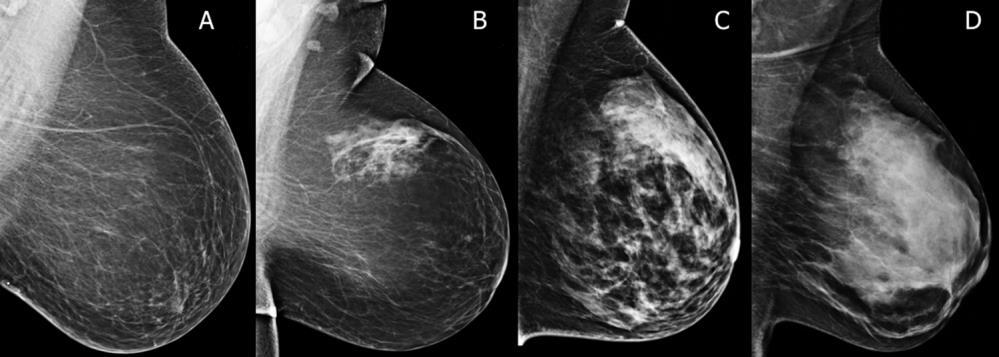 Dense Breasts, Get Educated What are Dense Breasts? The normal appearances to breasts, both visually and on mammography, varies greatly.