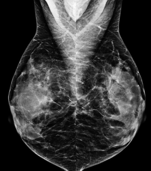 Why does breast density matter?
