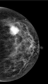 Density and Breast Cancer Risk MASKING-