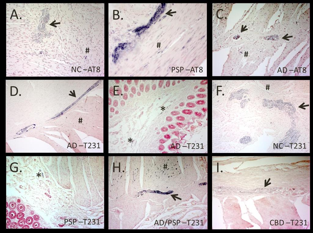 Figure 3. Phosphorylated tau immunoreactivity within the sigmoid colon. Photos A,C taken at 20x, D-H taken at 10x and B and I taken at 40x magnification.