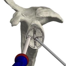 2 Definition of glenoid centre Please consider that the glenoid size to be used is determined by the previously selected humeral head size.