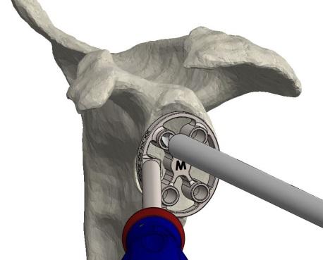 Use a power tool to ream the glenoid to the desired depth considering that the aim is to normalise the version whilst avoiding excessive thinning of