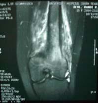 Bone lesions with a permeative pattern by X-ray Osteomyelitis Ewing s sarcoma Lymphoma (Non-Hodgkin s) Myeloma