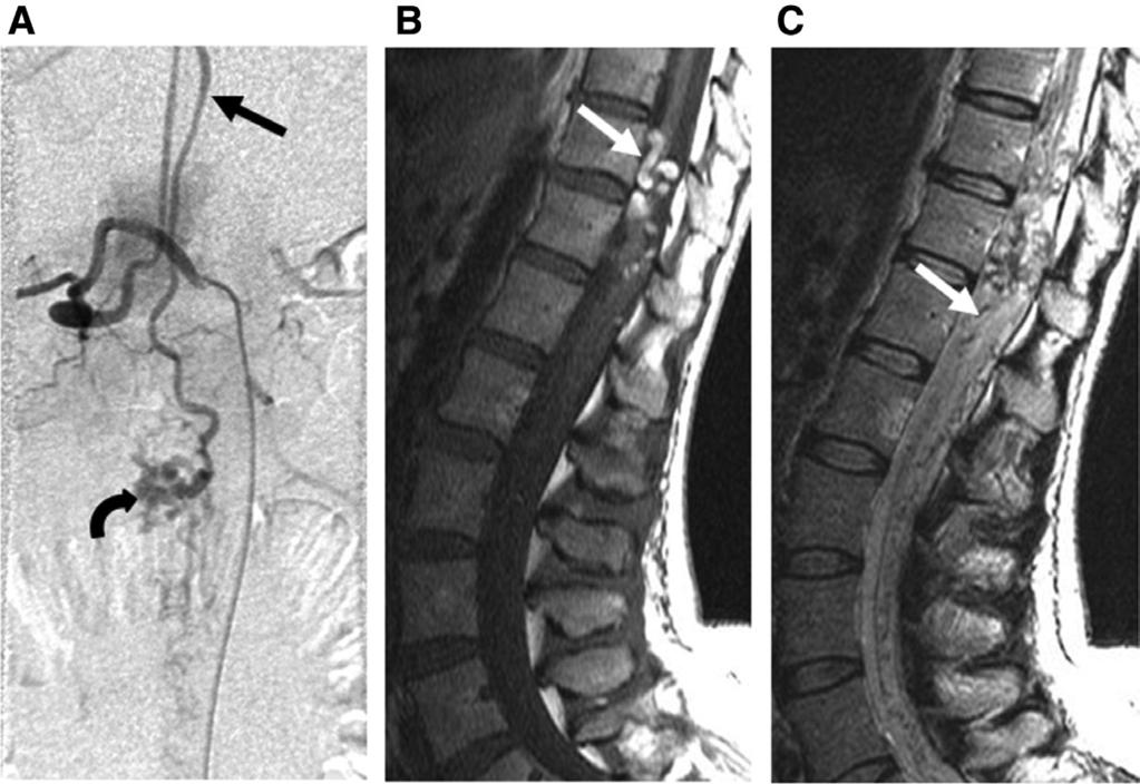 Lee et al Spinal Cord Pial AVMs 2609 Figure 1. Progression of clinical presentation from hemorrhage to myelopathy in a 42-year-old woman with nidus-type arteriovenous malformation.