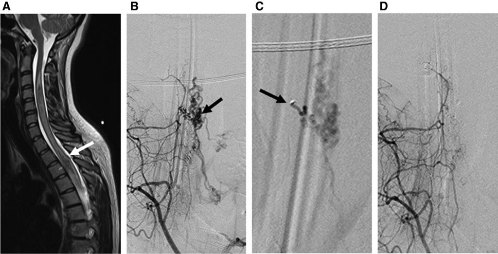 2610 Stroke September 2014 Figure 2. Complete obliteration of a nidus-type arteriovenous malformation (AVM) with embolization in a 17-year-old woman.