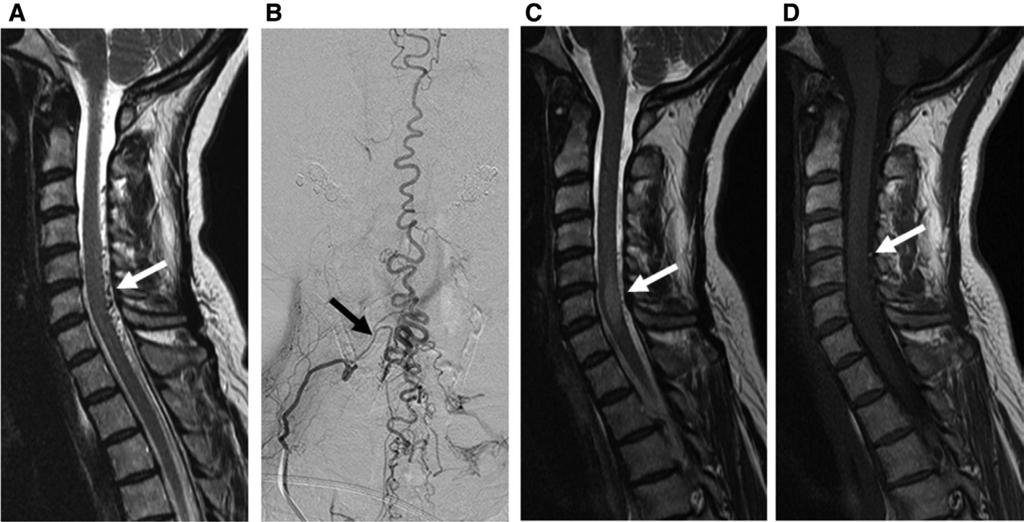 Spinal angiogram from right supreme intercostal artery shows a nidus-type AVM (arrow) supplied by the radiculopial artery arising from the segmental artery T3 (B).