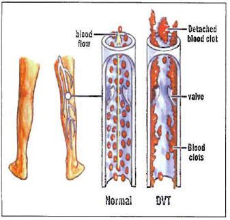 Deep Vein Thrombosis (DVT) What causes a clot? Whenever we cut ourselves, our body responds by thickening the blood, which makes it clot more rapidly.