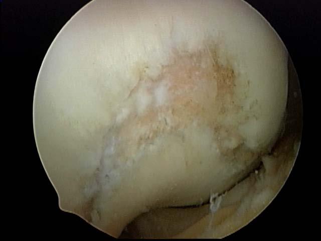 Where does orthobiologic osteochondral scaffold fit in?
