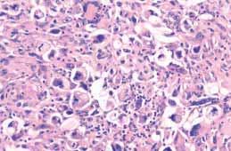 after carcinomas, melanomas and lymphomas have been excluded {675}. Immunohistochemistry was critical in helping to separate the latter non-mesenchymal malignancies.