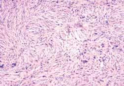 C The presence of polygonal cells with prominent eosinophilic cytoplasm usually suggests myogenic, epithelial or less often melanocytic differentiation.