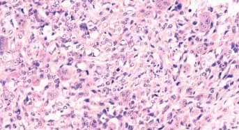 a variety of tumour types. The term giant cell MFH is currently reserved for undifferentiated pleomorphic sarcomas with prominent osteoclastic giant cells.