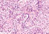 Giant cell tumour of soft tissues (see page 118) usually has a multinodular growth pattern and cytologically resembles giant cell tumour of bone {702, 1591,1608}.